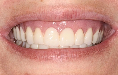 Smile gallary image - After